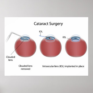 Poster de cirurgia catarata