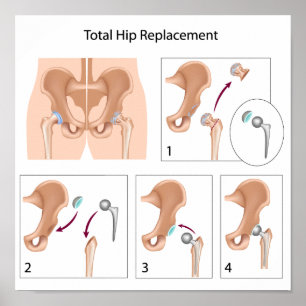 Poster de cirurgia de substituição total da anca