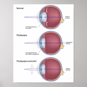 Poster de deformações oculares
