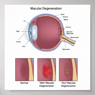 Poster de degeneração macular ocular