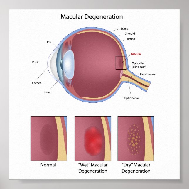 Poster de degeneração macular ocular (Frente)