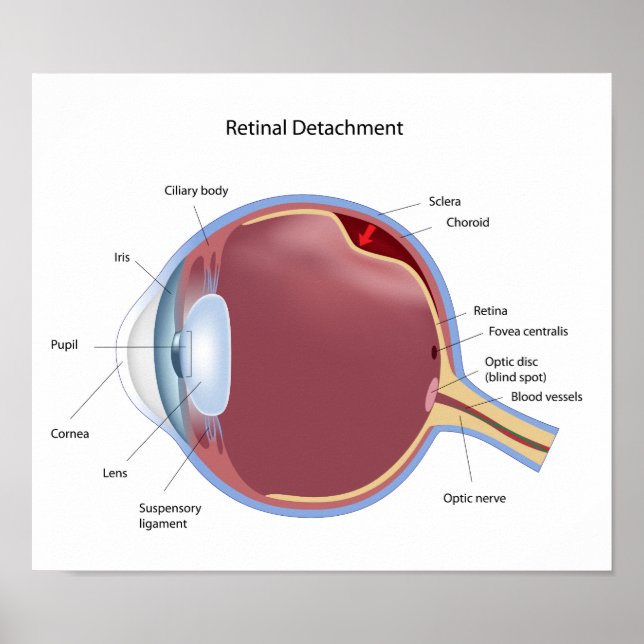 Poster de descolamento da retina ocular (Frente)