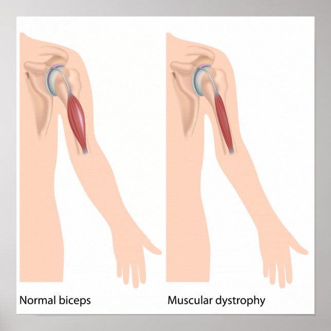 Poster de distrofia muscular (Frente)