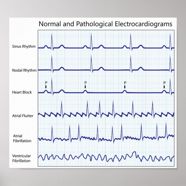 Poster de ecg normal e patológico (Frente)