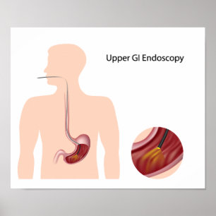 Poster de endoscopia GI superior