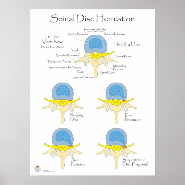 Poster de Hernição de Disco Spinal Poster Médico (Frente)