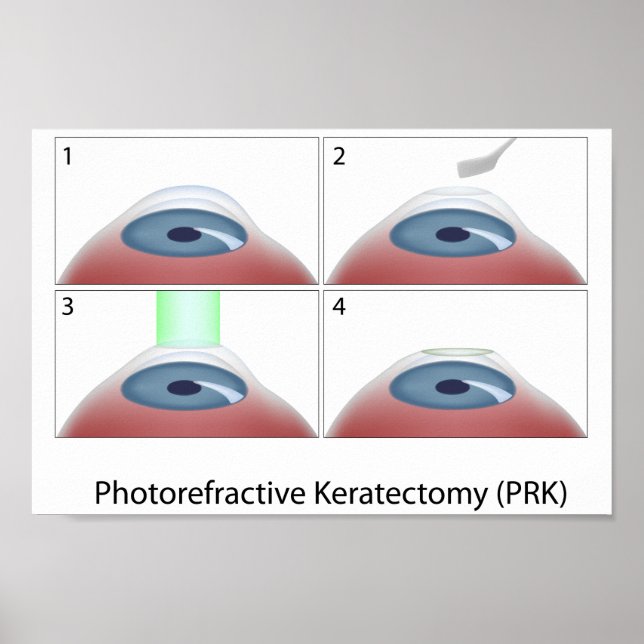 Poster de Keratectomia Fotorefrativa (PRK) (Frente)