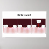 Poster de procedimento de implante dentário