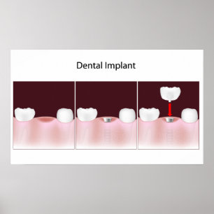 Poster de procedimento de implante dentário