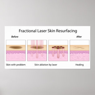 Poster de ressurreição da pele do laser fracionada