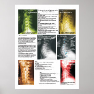 Poster Degeneração espinal cervical do Subluxation