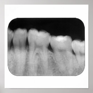 Poster Dentes com enchimento