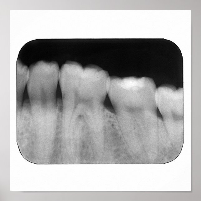 Poster Dentes com enchimento (Frente)