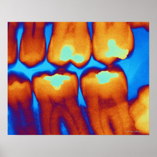 Póster Dentes com recheio (verde), raio-X colorido.