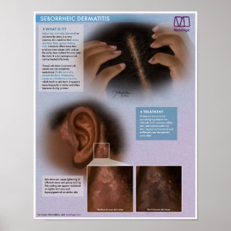 Poster Dermatite Seborreica Melálica (Dandruff) Médica