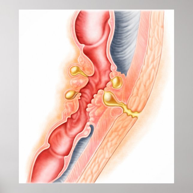 Póster Desenvolvimento De Fístula (Frente)