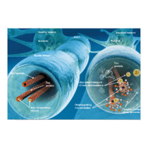 Desintegração de microtúbulos num neurônio