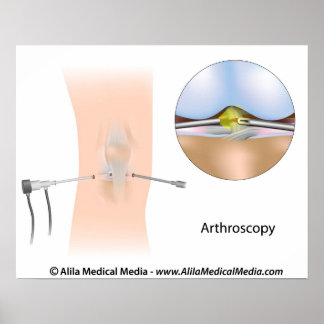 Poster Diagrama da artroscopia do joelho.