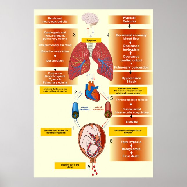 Poster Diagrama de um Embolismo de Fluido Amniótico (Frente)