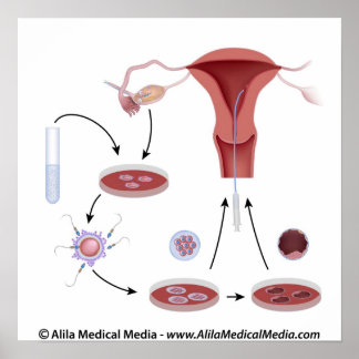 Póster Diagrama sem rótulo do procedimento IVF.
