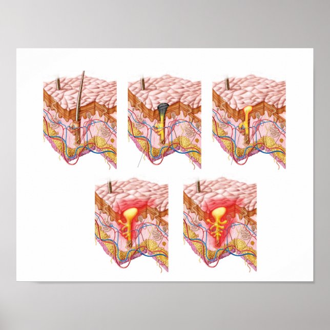Póster Diferentes Tipos De Acne (Frente)