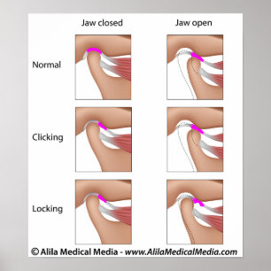Póster Disfunção das articulações temporomandibulares, TM
