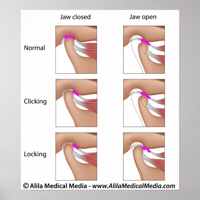 Póster Disfunção das articulações temporomandibulares, TM (Frente)