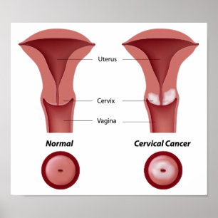 Poster do cancer Cervical