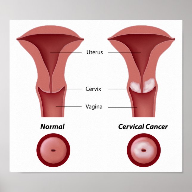 Poster do cancer Cervical (Frente)