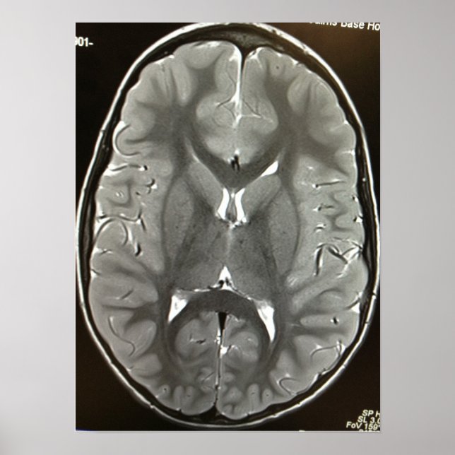 POSTER do Cérebro MRI (Frente)