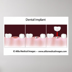 Poster do procedimento do implante dental