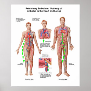 Poster Embolismo pulmonar, caminho do êmbolo