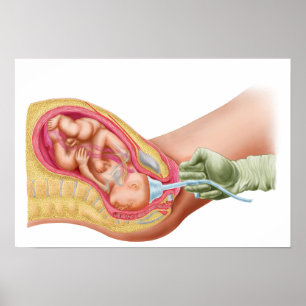 Poster Entrega do feto usando a extração do vácuo