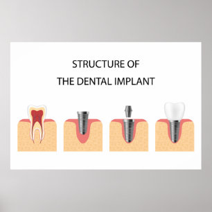 Poster Estrutura do implante dental
