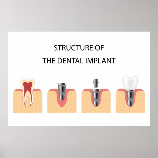 Poster Estrutura do implante dental (Frente)