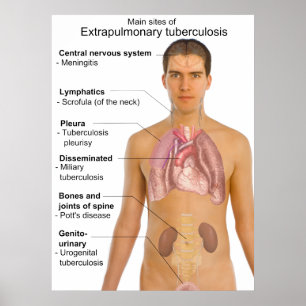 Poster Gráfico dos Principais Sintomas da Tuberculose Ext