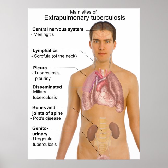 Poster Gráfico dos Principais Sintomas da Tuberculose Ext (Frente)