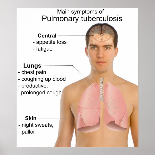 Poster Gráfico dos principais sintomas da tuberculose pul (Frente)