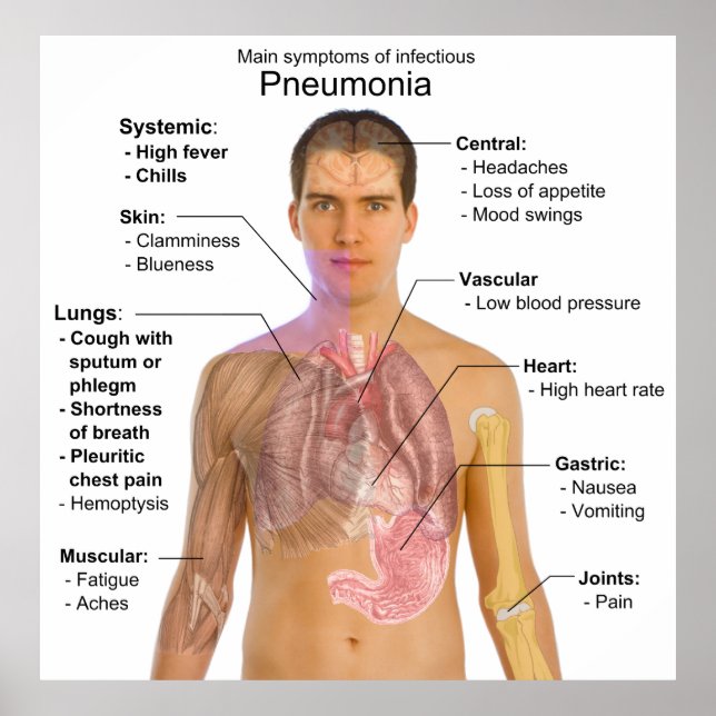Poster Gráfico dos Sintomas da Pneumonia (Frente)