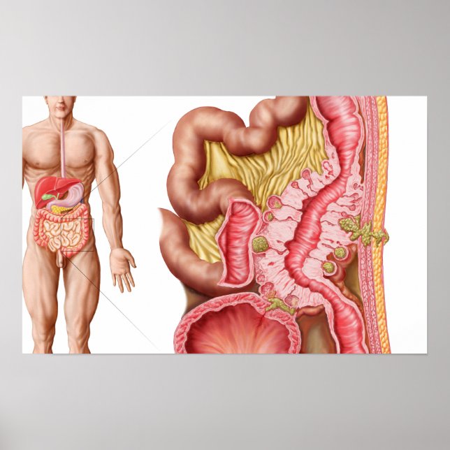 Poster Ilustração Da Diverticulose No Colão (Frente)