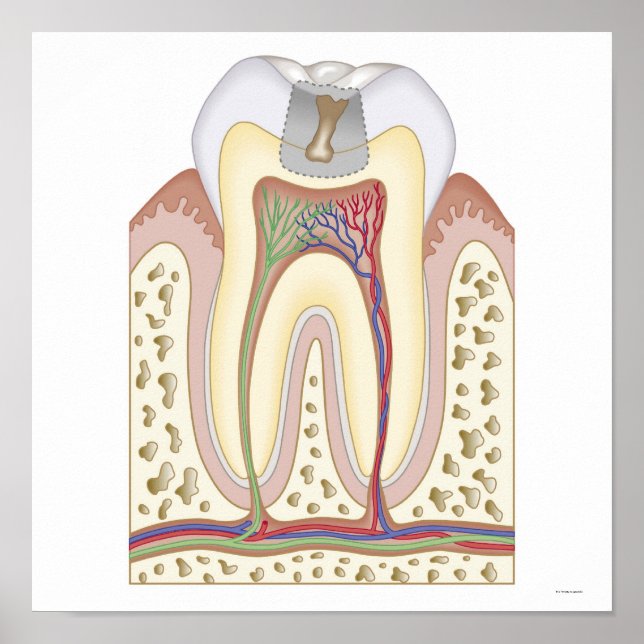 Póster Ilustração do Decaimento dos Dentes (Frente)