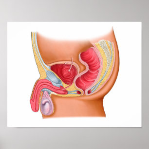 Póster Ilustração médica de uma fístula Rectourethral
