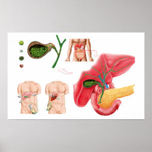 Poster Ilustração que descreve o Cholecystectomy
