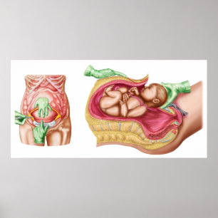 Póster Ilustração que mostra a entrega Caesarean do fet