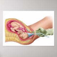 Ilustração Que Mostra A Entrega Do Feto 1