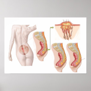 Poster Ilustration médico de um quisto Pilonidal