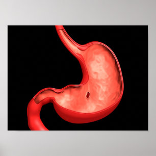 Poster Imagem conceptual da úlcera péptica no estômago