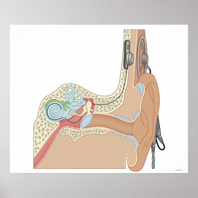 Póster Implantes Cocleares (Frente)