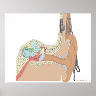 Poster Implantes cocleários