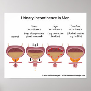 Póster Incontinência urinária masculina